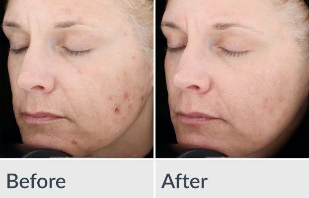 Before/After Chemical Peel