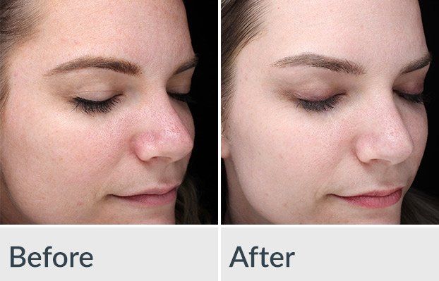 Before/After Chemical Peel