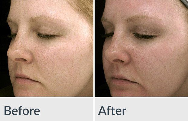 Before/After Chemical Peel