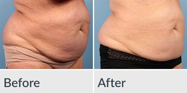 A before and after picture of a woman 's stomach