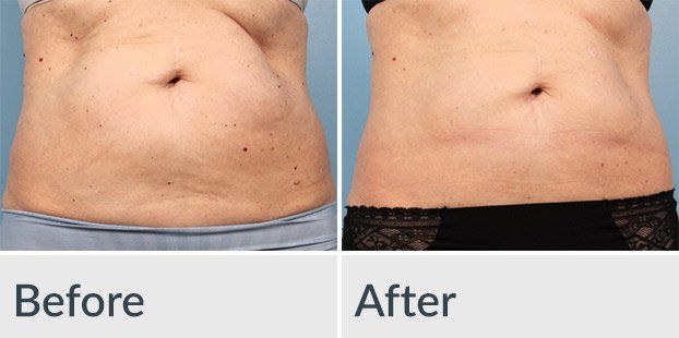 A before and after picture of a woman 's stomach