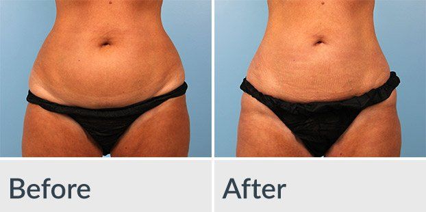 A before and after picture of a woman 's stomach