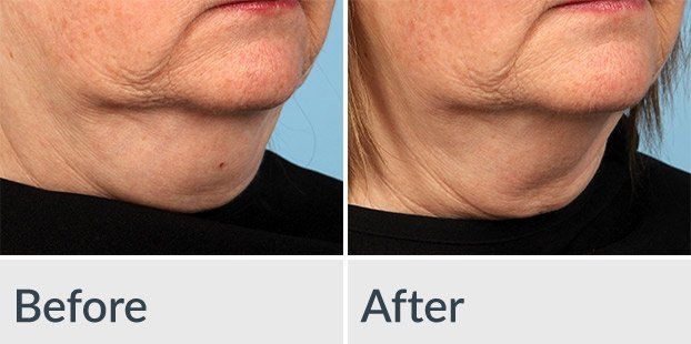 A before and after photo of a woman 's neck and chin.