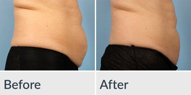 A before and after picture of a woman 's stomach