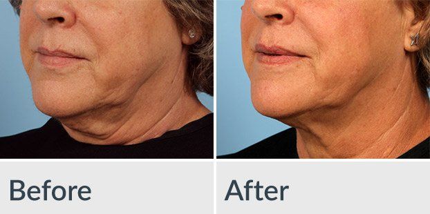 A before and after photo of a woman 's neck and face.