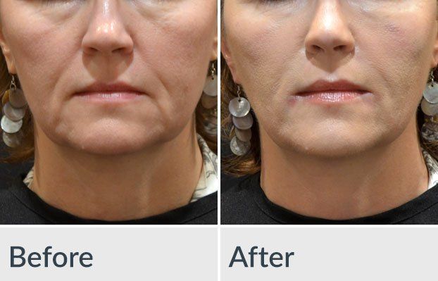 A before and after photo of a woman 's face
