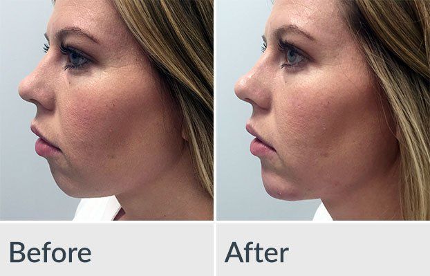 A before and after photo of a woman 's face.