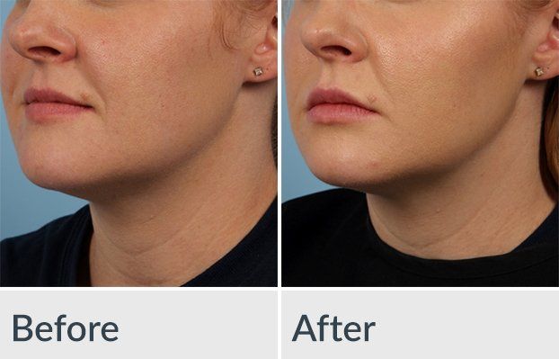 A before and after photo of a woman 's face