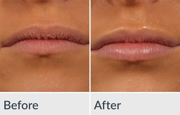 A before and after photo of a woman 's lips.