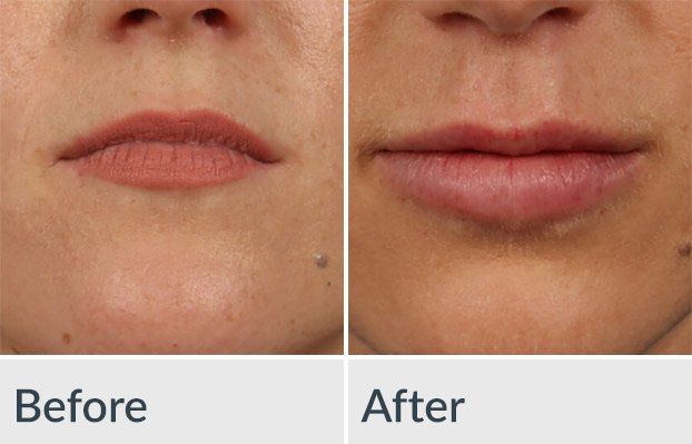 A before and after picture of a woman 's lips.