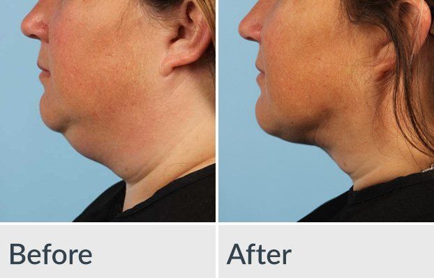 A before and after photo of a woman 's neck and face