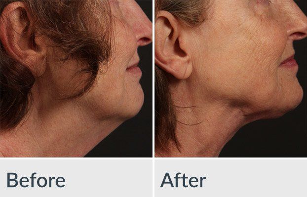 A before and after photo of a woman 's neck and face.