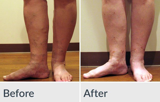A before and after photo of a person 's legs