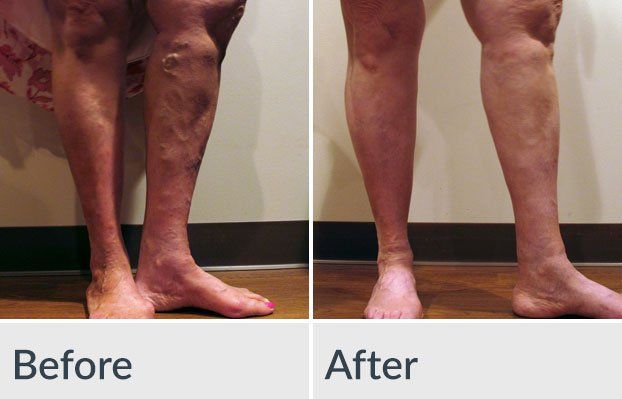 A before and after photo of a person 's legs with varicose veins.