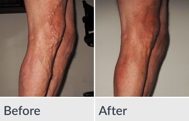 A before and after photo of a person 's legs with varicose veins.