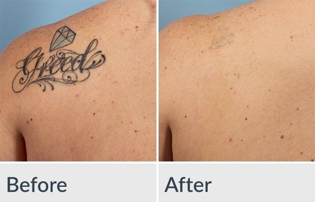 A before and after picture of a tattoo on a person 's back