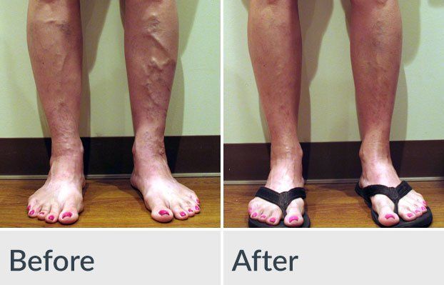A before and after photo of a woman 's legs with varicose veins