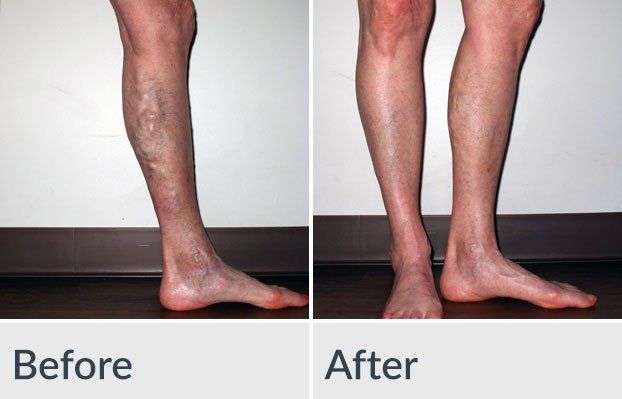 A before and after photo of a man 's legs with varicose veins