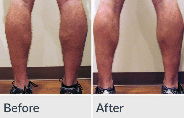 A before and after photo of a person 's legs