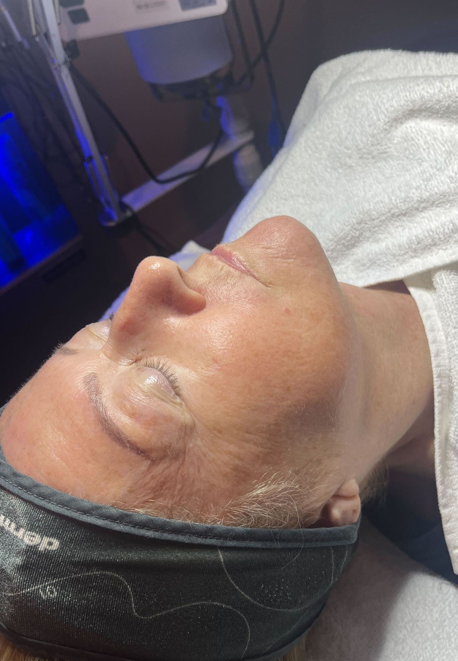 before & after facial