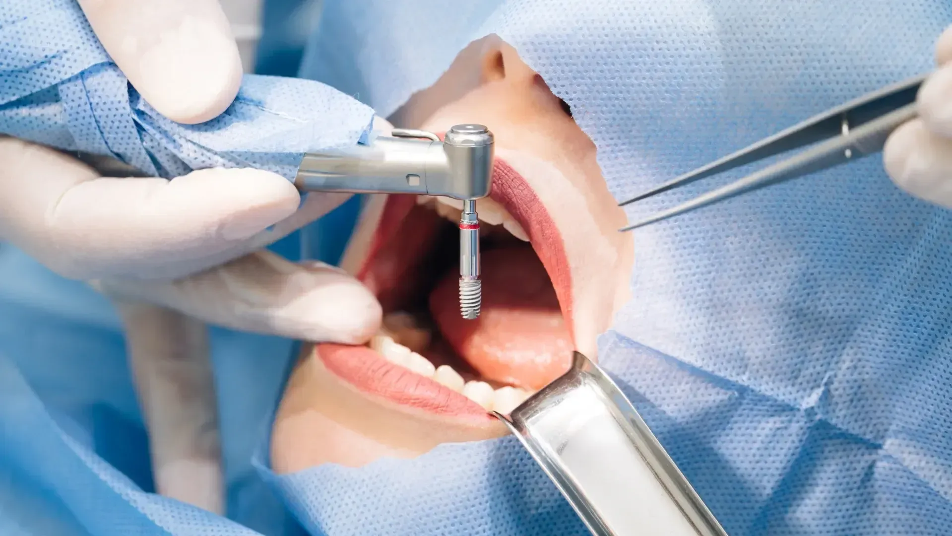 patient getting dental implant treatment