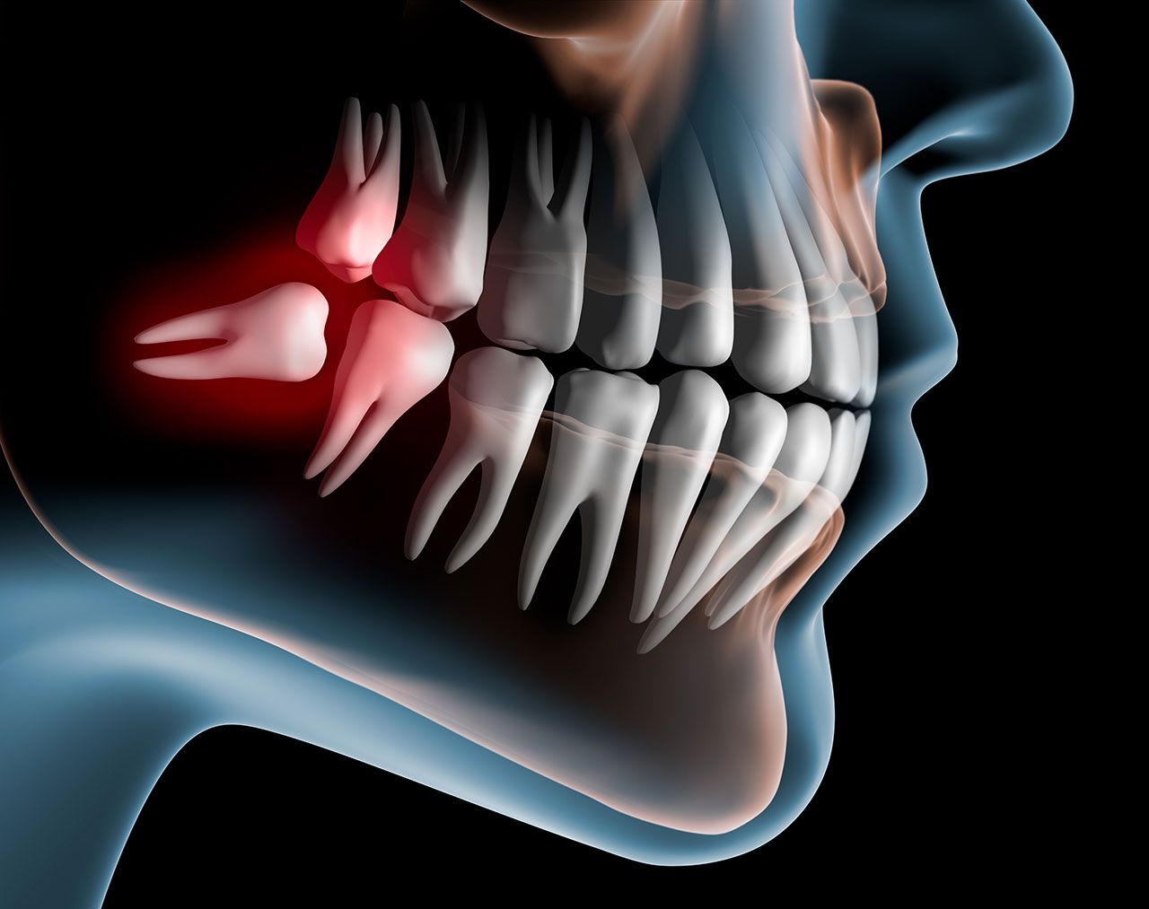 Wisdom Teeth Removal In Tampa: What To Expect Before, During, And After Treatment
