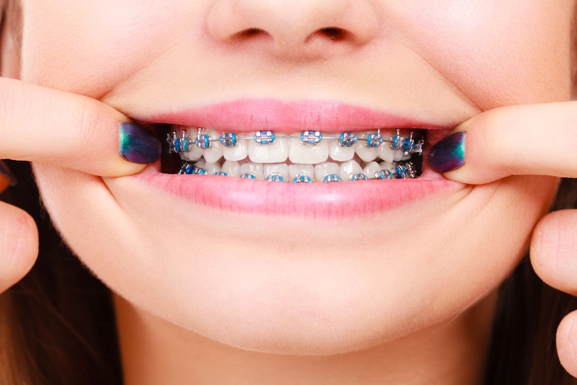 Woman with blue braces smiles widely, cheeks pulled back by hands.