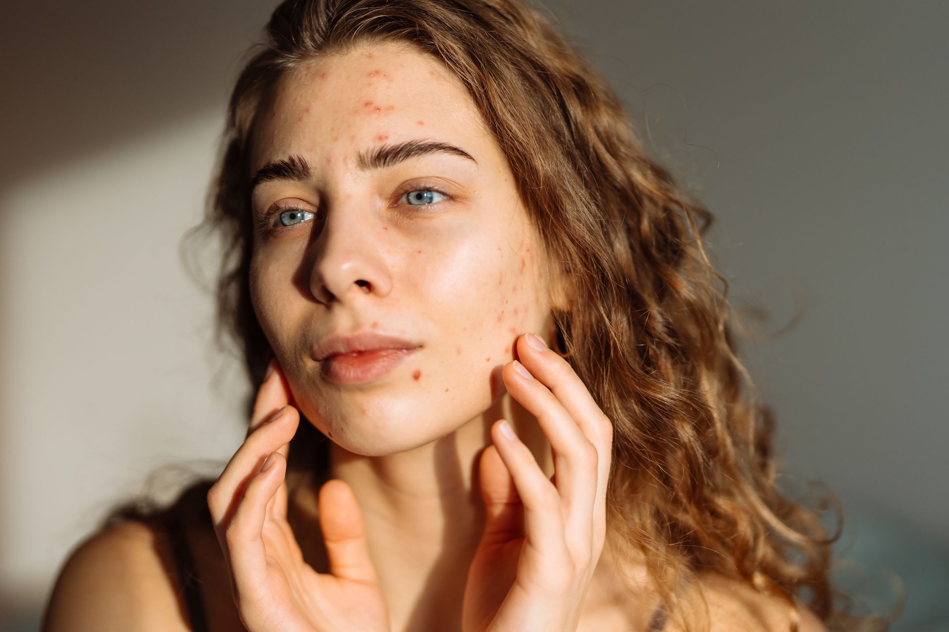A person with curly hair touches their face, which has visible blemishes, under soft lighting.