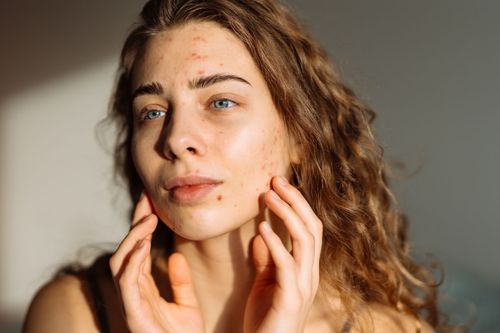 A person with curly hair touches their face, which shows signs of acne, in soft, side-lit indoor lighting.