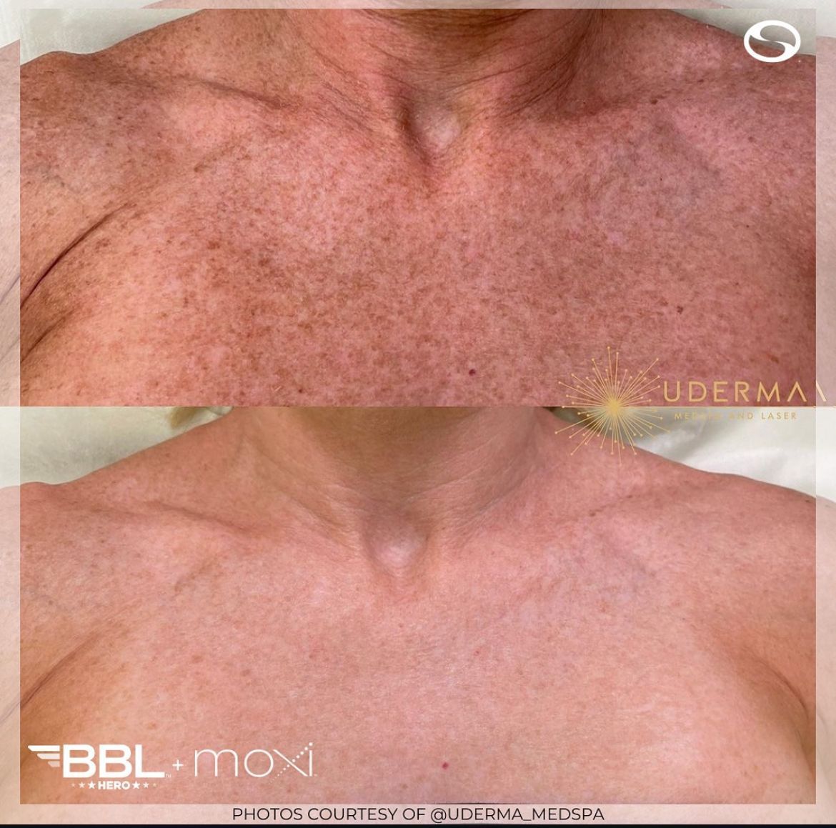 Before and after comparison of skin on a person's chest showing reduced pigmentation and sun damage after BBL/Moxi treatment.