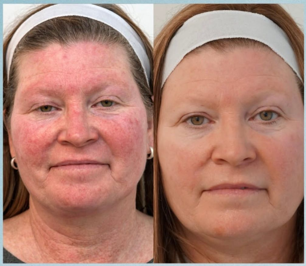 A before-and-after comparison showing reduced skin redness and improved tone on a person's face.