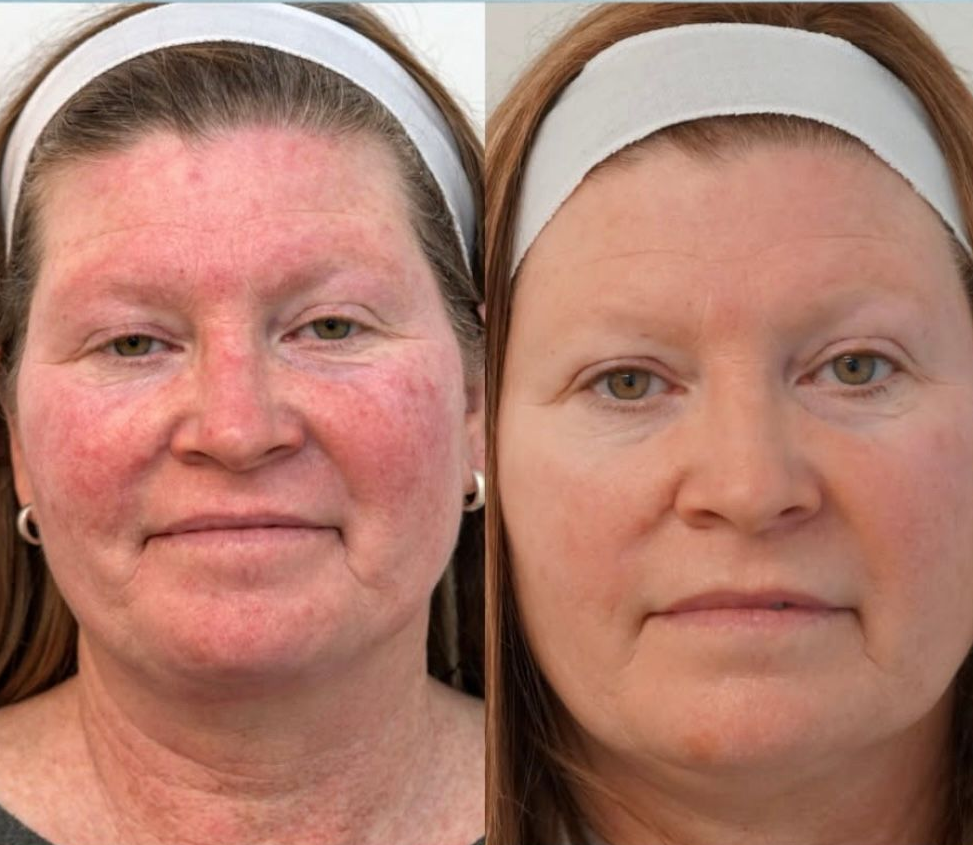 Before and after comparison of a person's facial skin redness, showing a reduction in inflammation and improved tone.