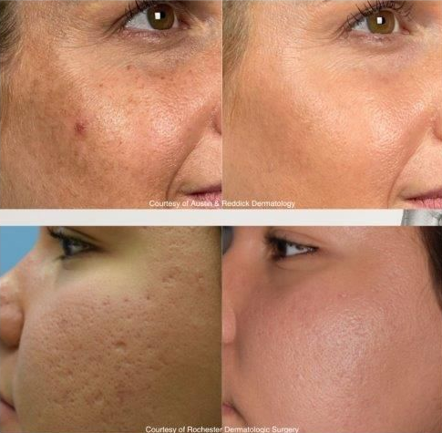Before and after photos comparing skin tone improvements and acne scar reduction after dermatological treatment.