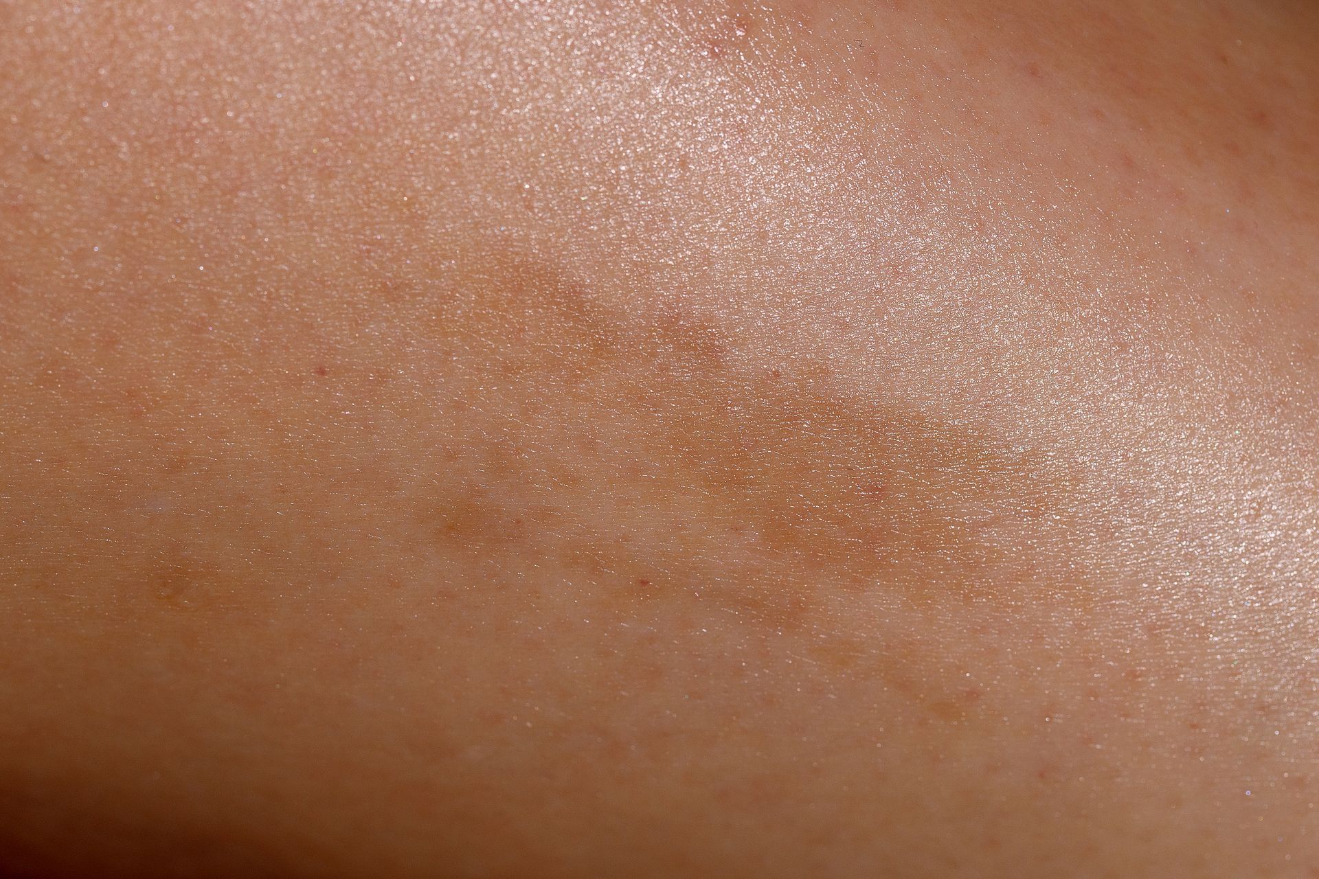 A close-up view of skin showing a linear patch of hyperpigmentation with a light brown, slightly textured appearance.