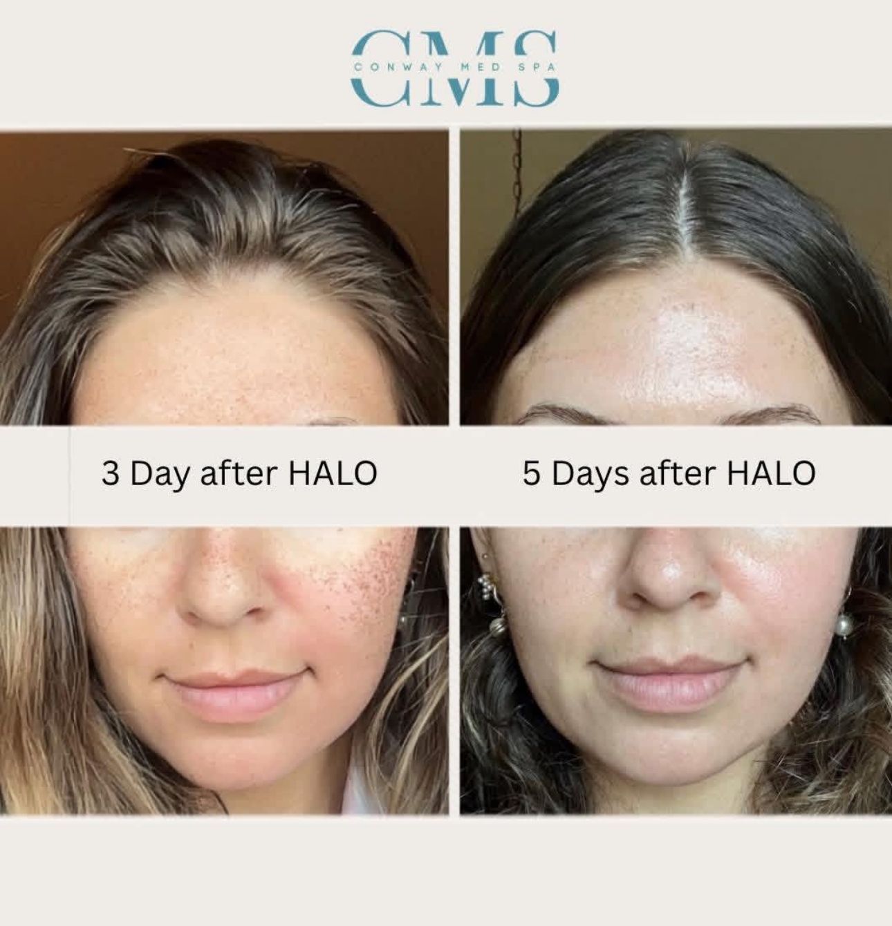 Before-and-after comparison showing facial skin recovery 3 and 5 days after a HALO laser treatment.