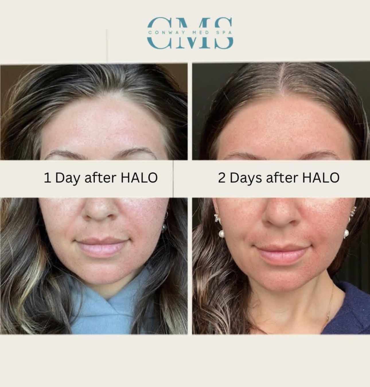 Before and after comparison of a patient's face, showing skin redness one and two days after a HALO laser treatment.