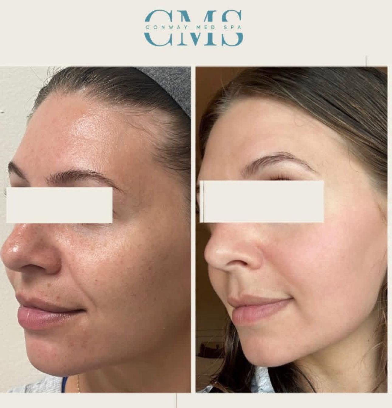 A comparison of skin texture and tone on a person's face before and after professional cosmetic treatment.