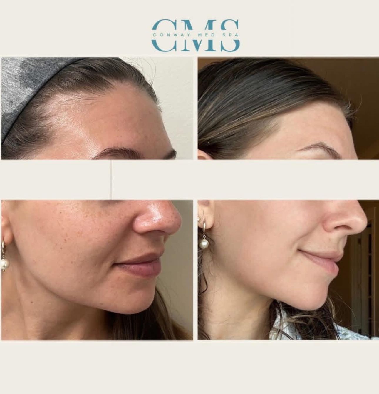 Before-and-after comparison showing smoother skin texture and reduced visible pores after a facial treatment.