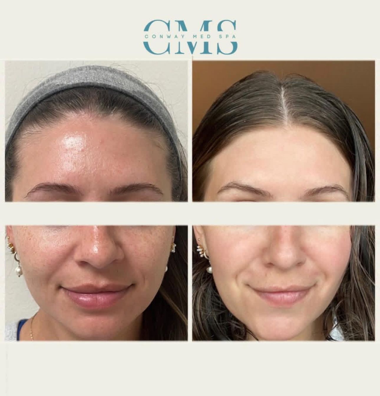 Before and after comparison of a person's facial skin showing reduced texture and improved tone after treatment.