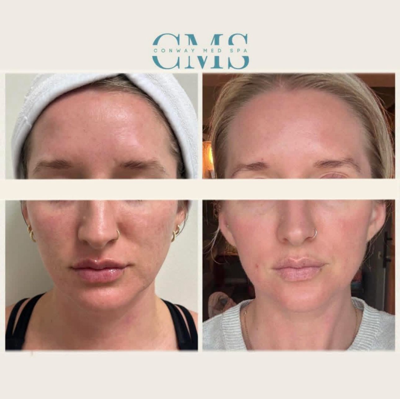 Before and after comparison of a patient's face showing skin texture improvement after a cosmetic treatment.