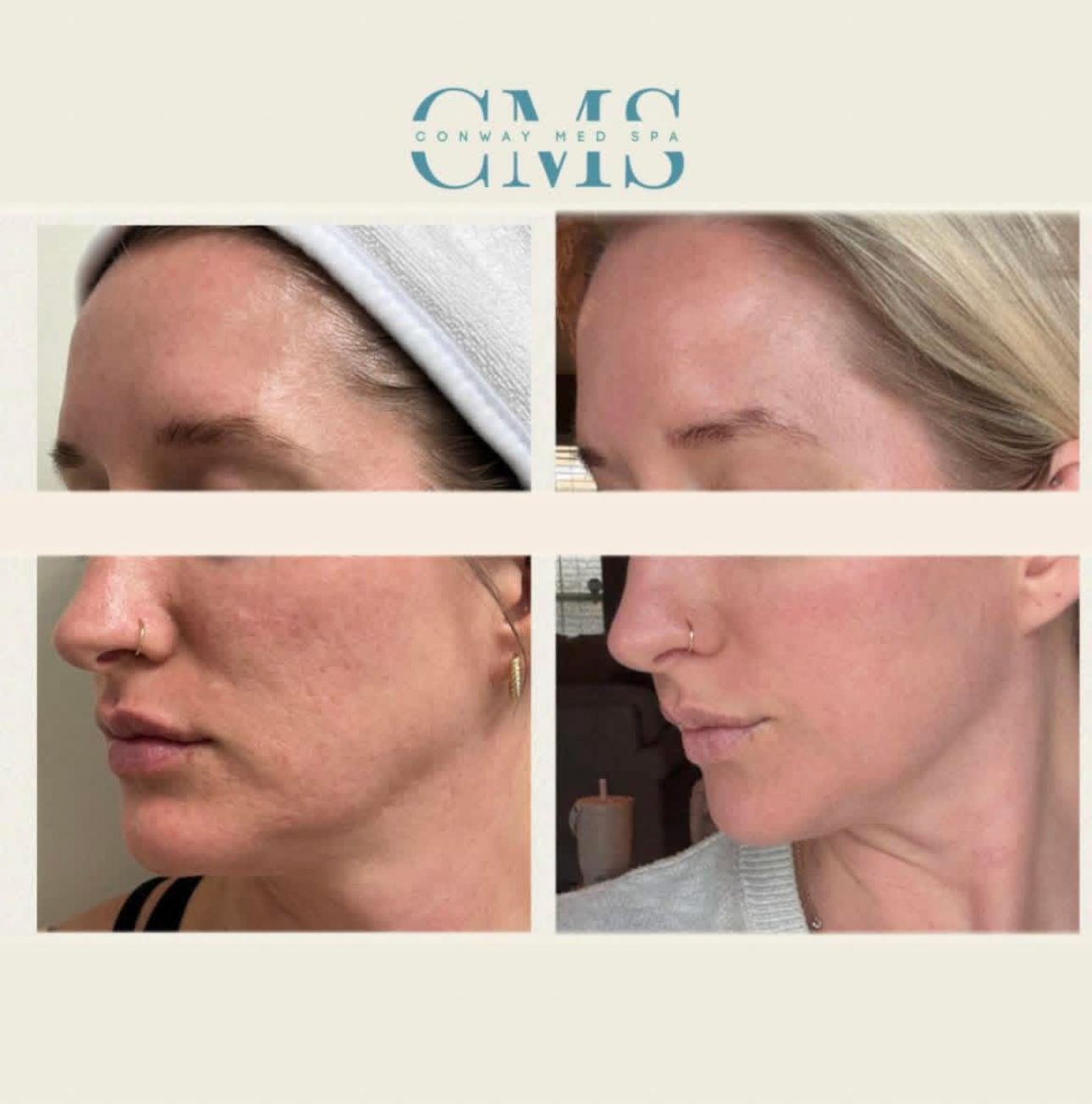 Before and after comparison of skin texture improvements showing a smoother, more even complexion on a person's face.