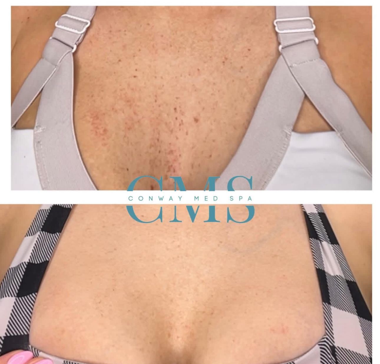 Before and after photos of chest skin, showing a reduction in redness and uneven texture after a cosmetic treatment.