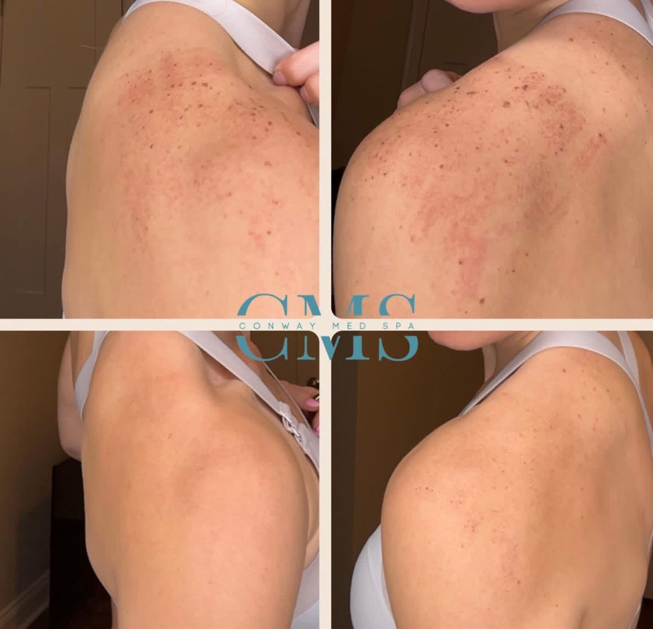 Four panels showing a close-up of skin on a shoulder before and after a treatment, highlighting reduced redness.