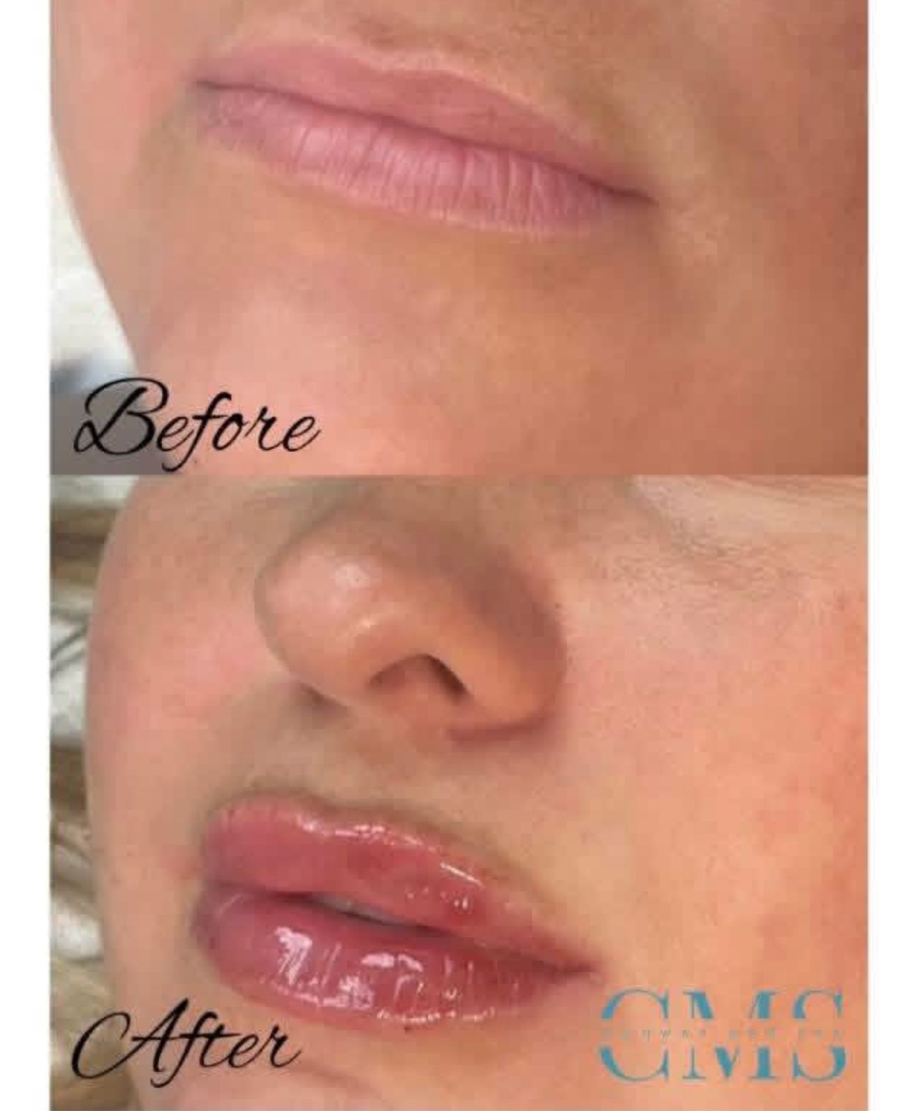 A before and after comparison of lips showing the results of a cosmetic lip filler procedure.