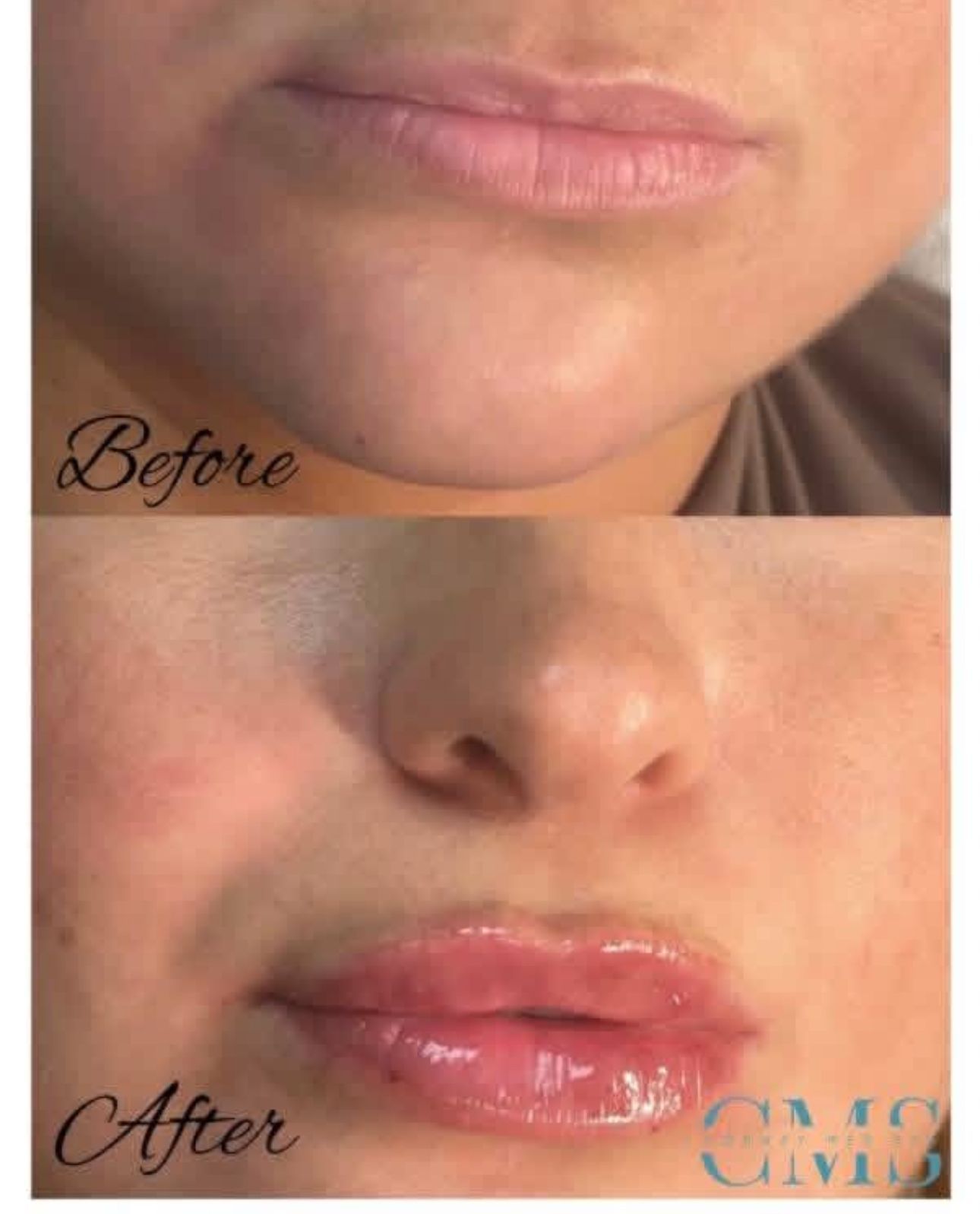 Before and after comparison showing increased lip volume and definition following a cosmetic procedure.