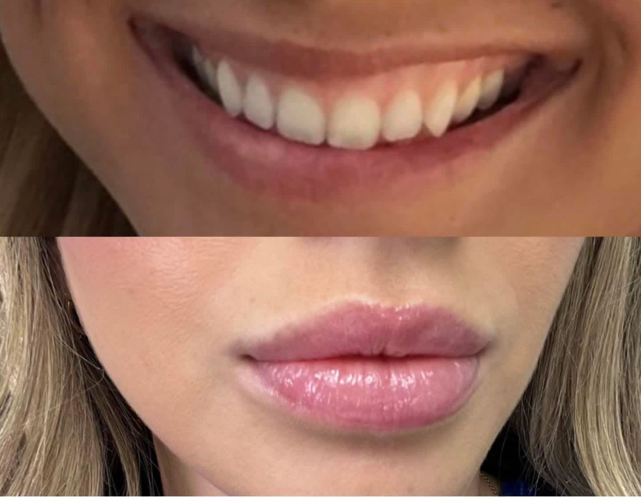 A split image showing a close-up of a smile with visible teeth above a close-up of neutral-toned, full lips.