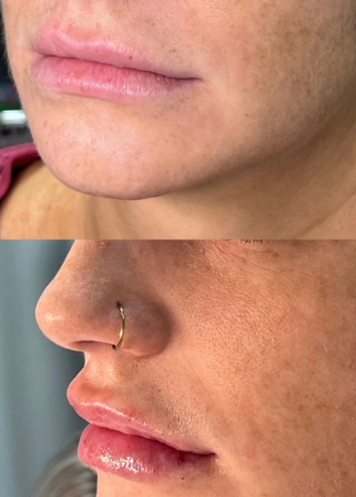 Before and after comparison of lip filler treatment showing an increase in volume and definition.
