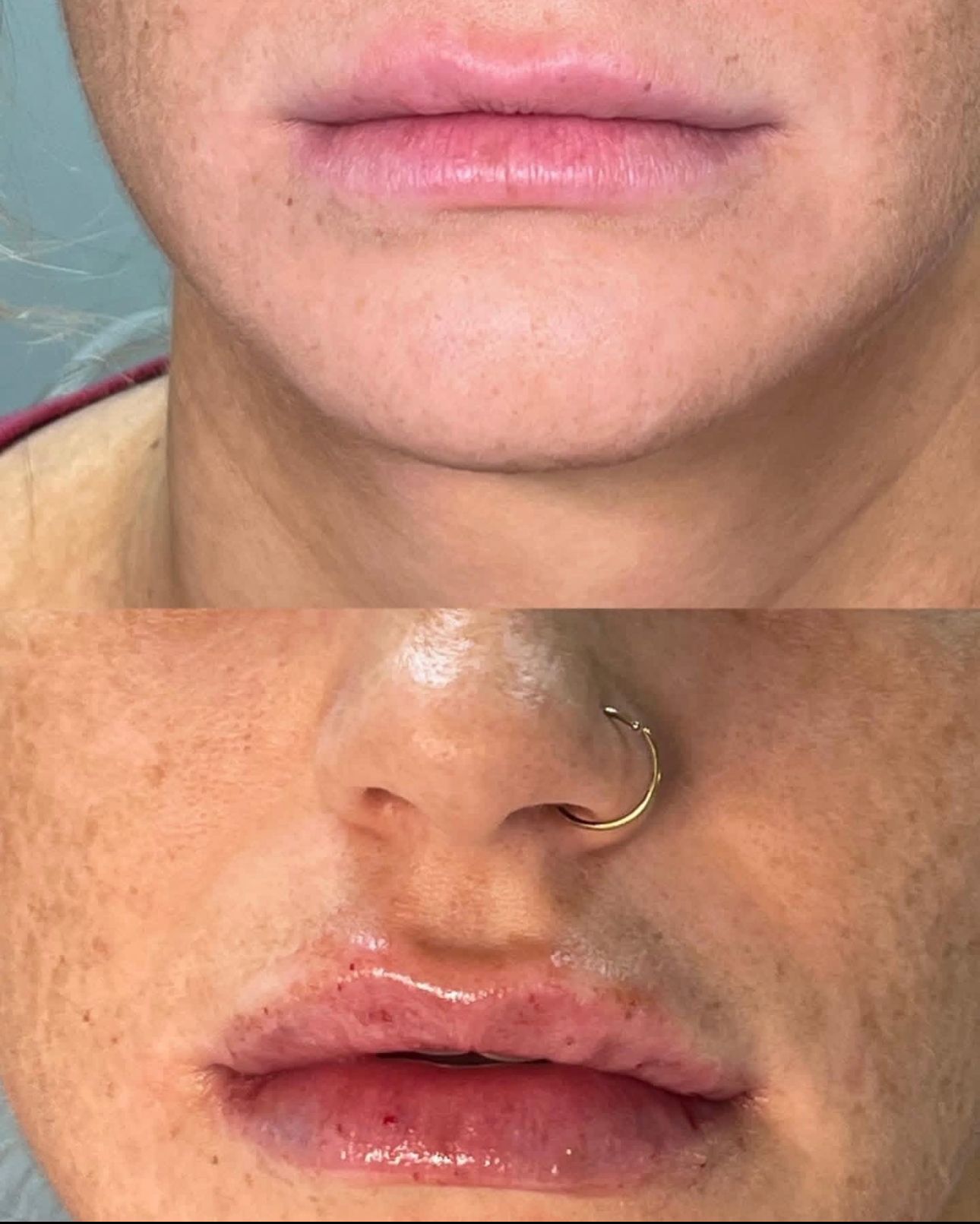 Before and after photos of lips, showing a fuller appearance after cosmetic injection, with minor redness and swelling.