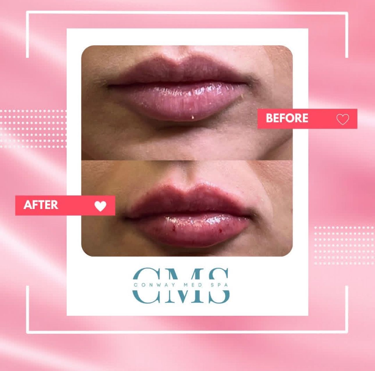 A before-and-after comparison showing lip augmentation results, featuring a logo for CMS Med Spa on a pink background.