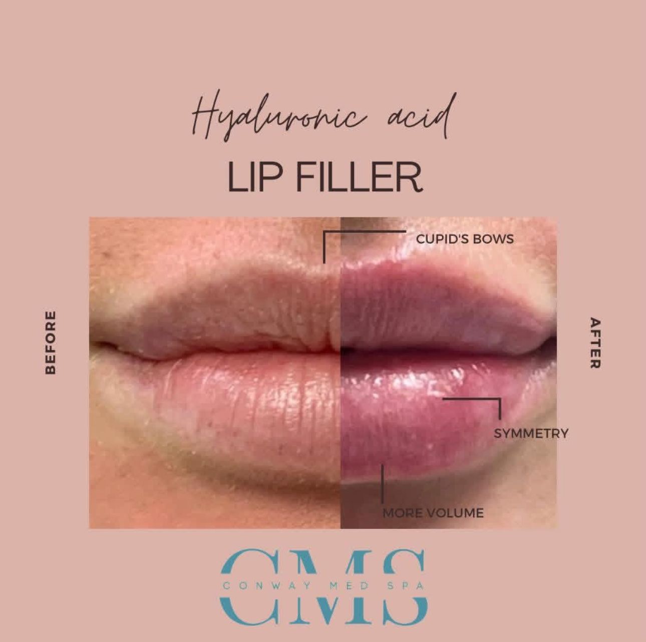 Before and after comparison of lips after hyaluronic acid filler treatment, showing increased volume and symmetry.